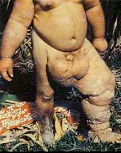 Название: elephantiasis.jpg
Просмотров: 4162

Размер: 11.6 Кб